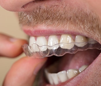 The Invisalign advantage