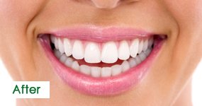 After Teeth Whitening, Case 1