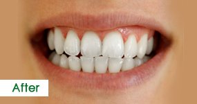 After Teeth Whitening, Case 2