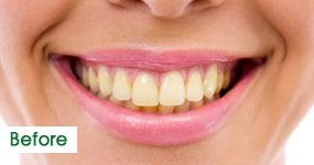 Before Teeth Whitening, Case 1