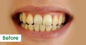 Before Teeth Whitening, Case 2