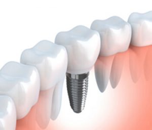 Implant Restoration