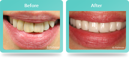 Smile Gallery Weybridge, Dental Photos Weybridge - Smile Gallery Image 03