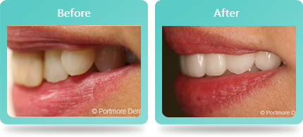 Smile Gallery Weybridge, Dental Photos Weybridge - Smile Gallery Image 04