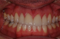 Smile Makeover Farmington Hills - Before Image