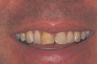 Smile Makeover Farmington Hills - Before Image