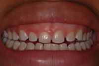 Smile Makeover Farmington Hills - Before Image