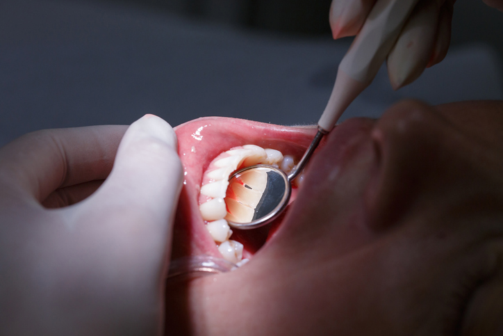 Gum disease treatment by stage from a periodontist in Farmington Hills