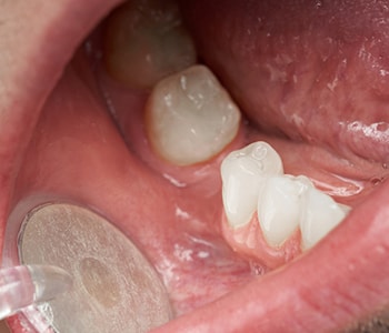 Effective gum disease treatment for patients in Farmington Hills