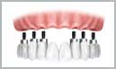 Denture Dentist Sutton