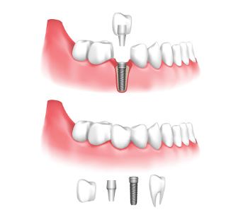 Implant treatment performed by your dentist in Austin with specific goals in mind